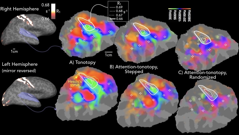 Eight colorized brain scans with portions of the brain highlighted and labelled indicating centers of audio processing